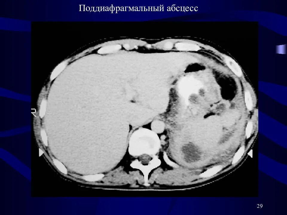 Поддиафрагмальный абсцесс кт. Подпеченочный абсцесс кт. Рентген поддиафрагмального абсцесса. Поддиафрагмальный абсцесс печени кт. Наличие гноя в брюшной полости