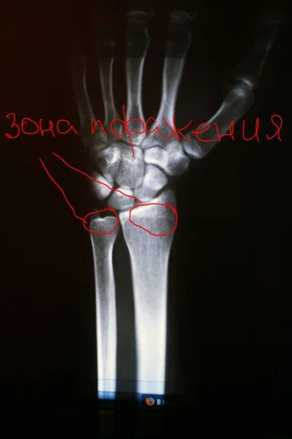 перелом лучевого отростка со смещением. перилунарный вывих кисти рентген. отрыв шиловидного отростка лучевой кости рентген. перелом лучевого отростка со смещением. перелом лучевого отростка со смещением.