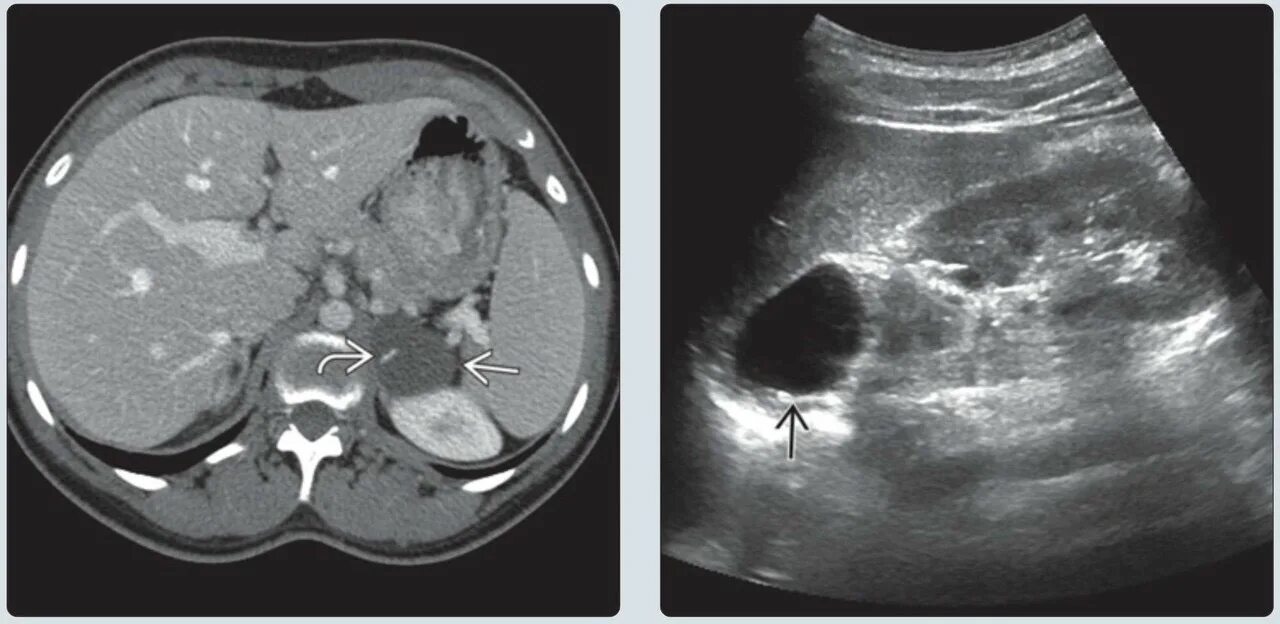 Надпочечники по узи. Кровоизлияние в надпочечник. Опухоли надпочечников мрт. Киста левого надпочечника. Андрогенитальный синдром у мальчиков.