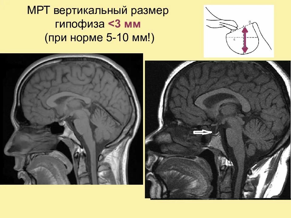 Гипофиз мрт норма. Мрт турецкого седла. нормальный гипофиз на мрт. гипофиз на мрт норма. мрт гипофиза.