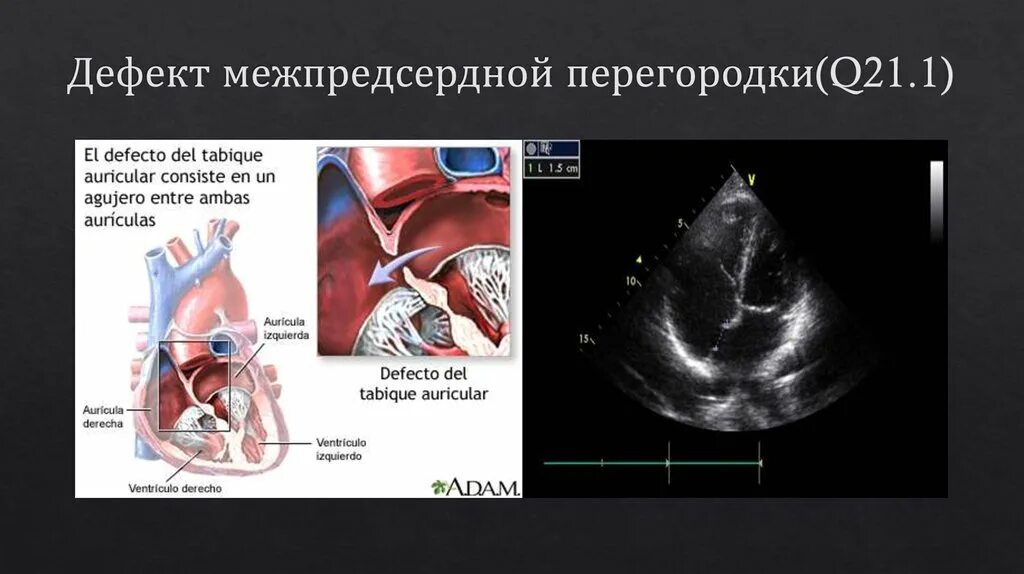 Аневризма перегородки у ребенка. Пороки межпредсердной перегородки ЭХОКГ. Врожденный порок сердца дефект межпредсердной перегородки. Врожденный порок сердца ДМПП. Первичный дефект межпредсердной перегородки эхокардиография.