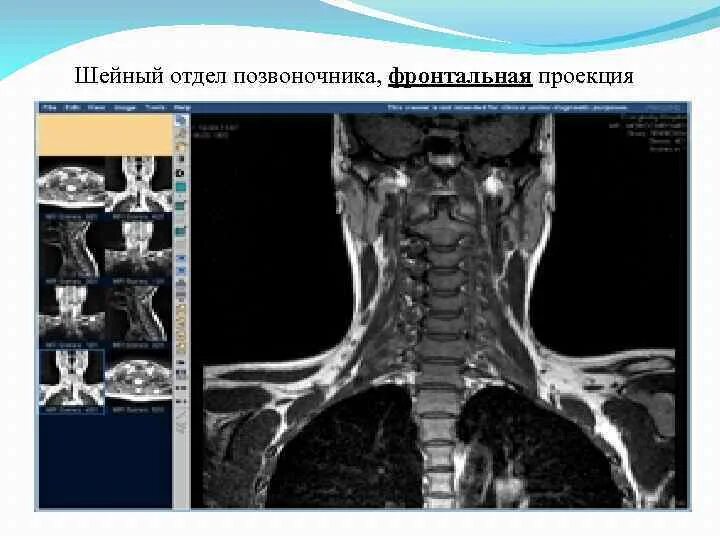 Мрт шейного отдела позвоночника по времени. Мрт анатомия шейного отдела позвоночника. Мрт шейного отдела позвоночника снимки. Шейный отдел позвоночника передняя проекция.