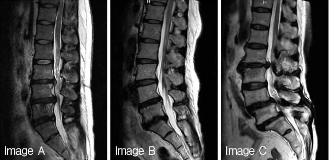Дегенерация дисков по pfirrmann. Дегенерация диска. Спондилолистез l5 кт. Дегенерация дисков по pfirrmann. Дегенеративные изменения межпозвонковых дисков по pfirrmann.