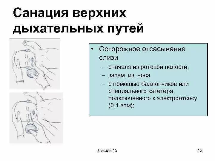 Как почистить мокроту. Отсасыватель слизи из верхних дыхательных путей у новорожденных. Санация верхних дыхательных путей. Отсасывание слизи у новорожденного из верхних дыхательных путей. Санация новорожденного алгоритм.