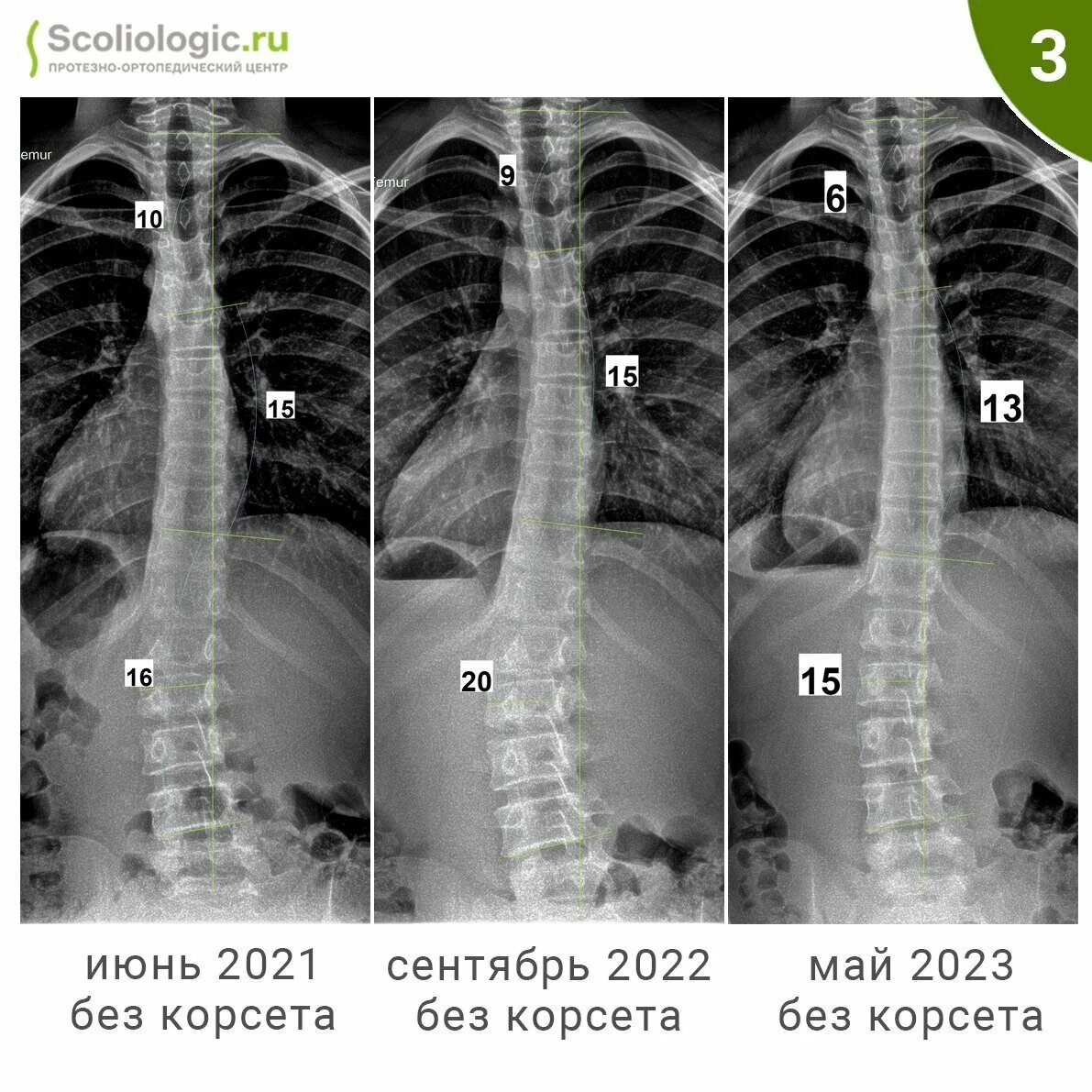 Сколиоз 2 степени это. Сколиоз по чаклину 2 степени. Сколиоз 2 степени 16 градусов. Принципы консервативного и оперативного лечения сколиоза. Сколиоз 8 градусов.