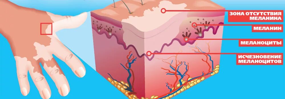 В собственно коже отсутствует пигмент. Меланоциты меланин кожа. Заболевание кожи витилиго.