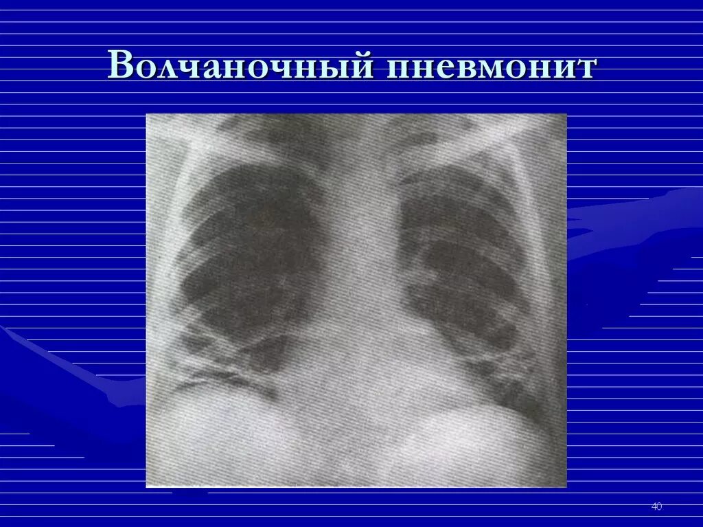 Криптококкоз головного мозга гистология. Поражение лёгких при системной красной волчанке. Красная волчанка легких. Красная волчанка легких. Системная красная волчанка клетки le.
