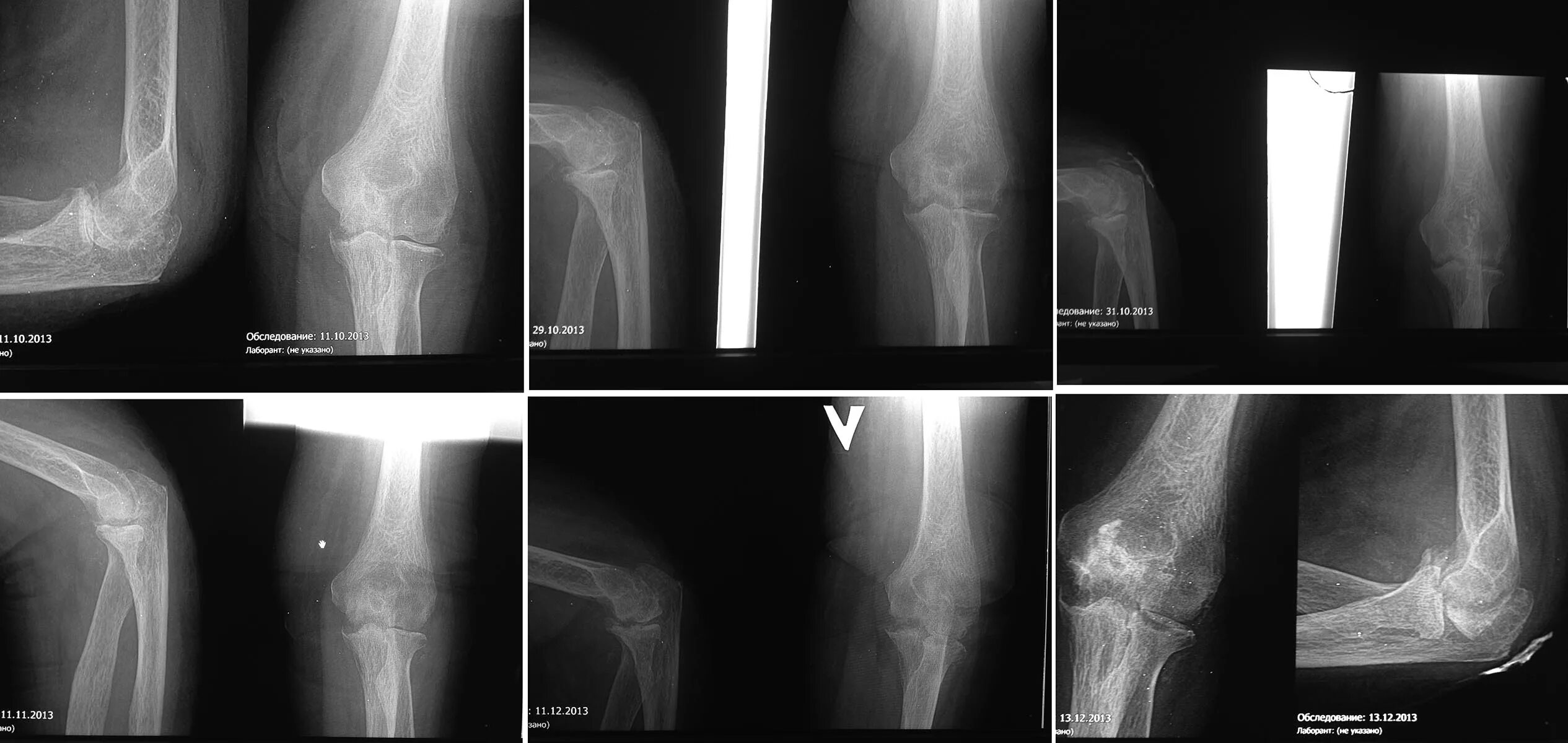 гонартроз коленного сустава стадии. эндопротезирование локтевого сустава артропластика. артроз локтевого сустава. остеонекроз коленного сустава. краевые остеофиты суставных поверхностей локтевого сустава.
