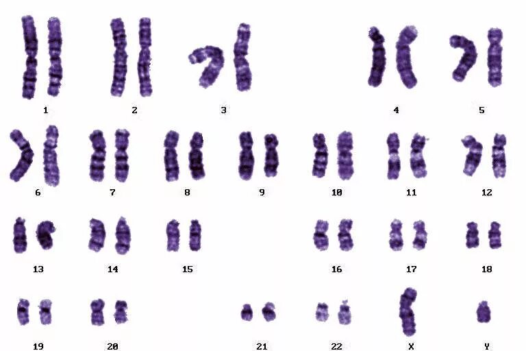 Хромосомные мутации. Хромосомы человека. Мутированные хромосомы. Поврежденная хромосома.
