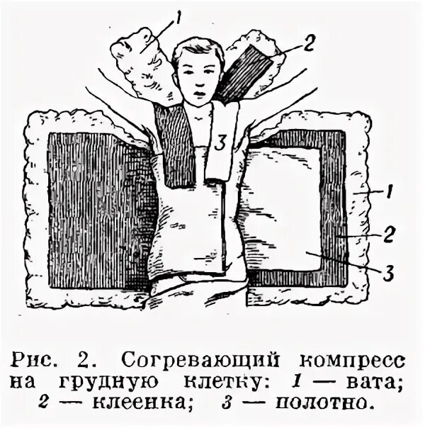 Компресс на кожу алгоритм. Согревающий компресс на грудную. согревающий компресс на грудь. согревающий компресс на молочную железу. схема постановки согревающего компресса.