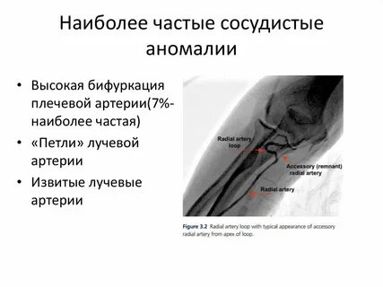 Бифуркация артерии