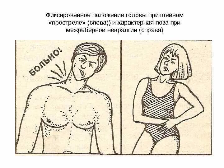 Как снять межреберную невралгию. Как снять межреберную невралгию