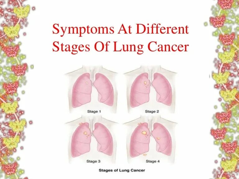 Stages of cancer