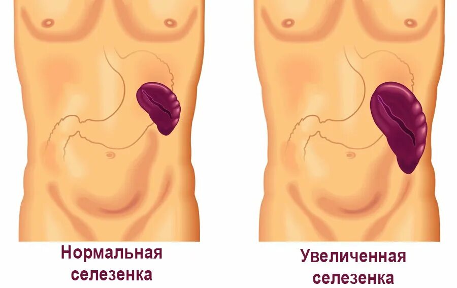 У подростка увеличена селезенка. Спленомегалия и гиперспленизм. Невоспалительная спленомегалия.