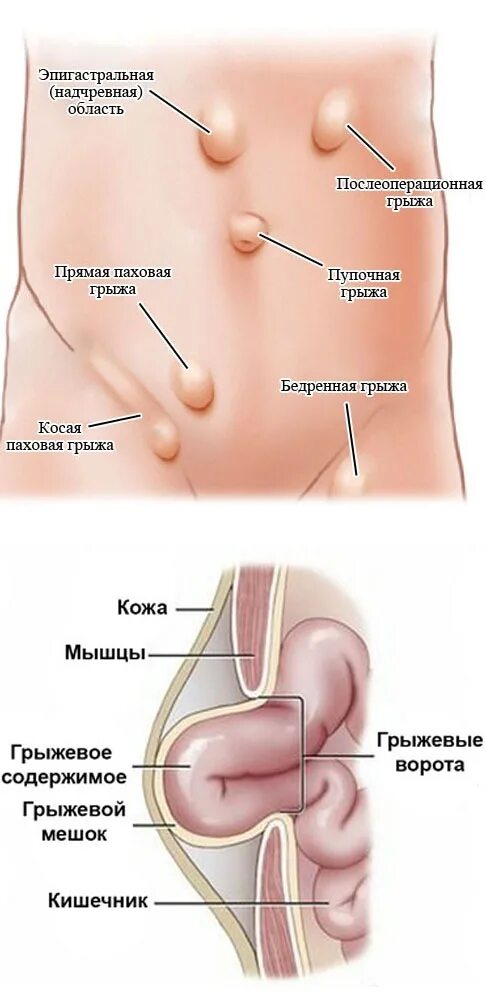 Грыжа слева симптомы. Вентральная грыжа пупочная околопупочная. ущемленная эпигастральная грыжа. грыжевые ворота паховой грыжи у мужчин. схема паховой грыжи у мужчин.