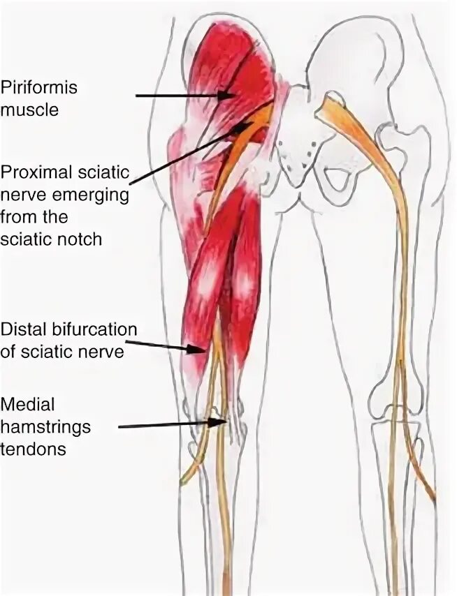 Мышца седалищного нерва. Мышцы задней поверхности бедра и седалищный нерв. Защемление седалищного нерва грушевидной мышцей. Седалищный нерв пережат мышцами. Нервы на ягодицах.