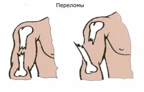 Перелом в жизни человека