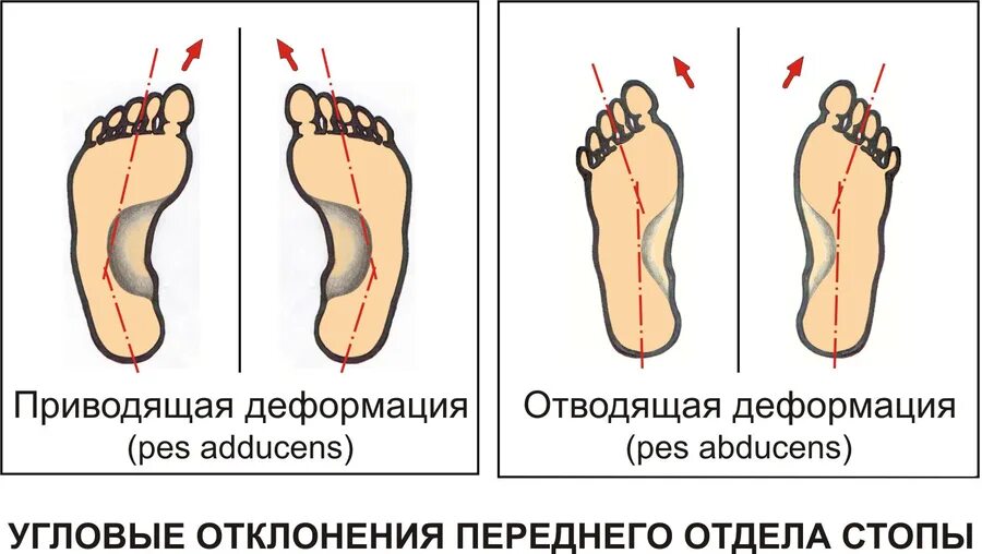 Пятки внутрь. Вальгус вальгус плоскостопие. Вальгусная деформация искривление стопы. Степени вальгусной деформации 1 пальца. Классификация вальгусной деформации 1 пальца стопы.