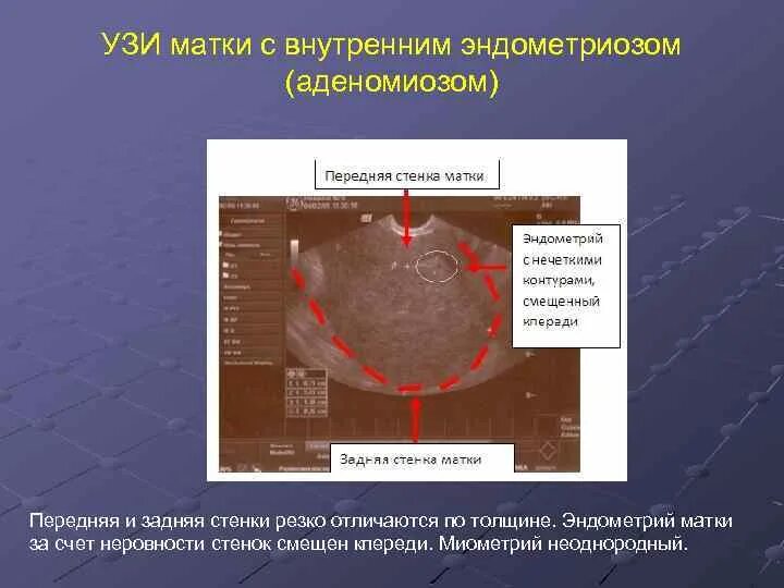 Эндометрия стенок матки. Передняя и задняя стенка матки. Задняя стенка матки на УЗИ. Передняя стенка матки на УЗИ.