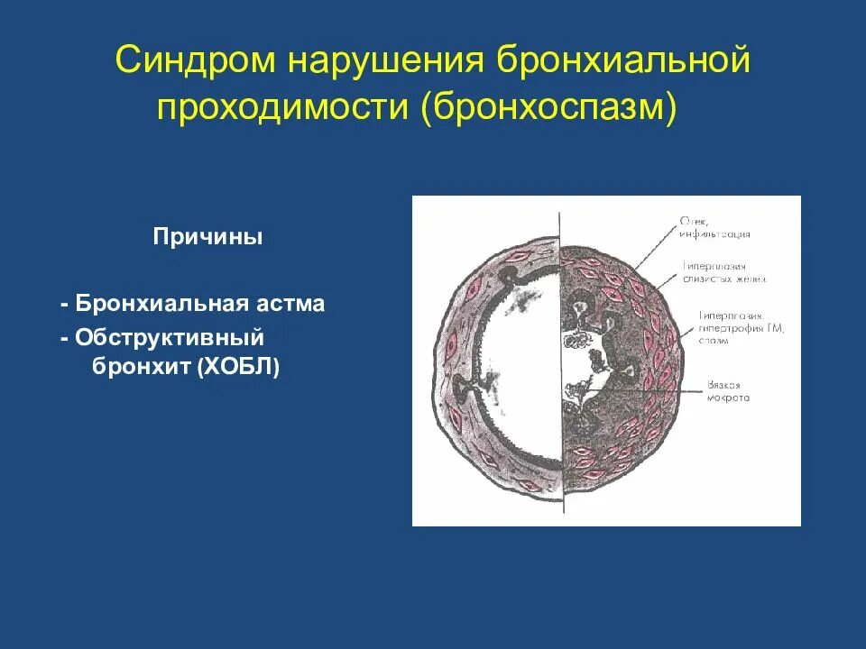 Обструктивное нарушение бронхиальной проходимости. Синдром нарушения бронхиальной проходимости. причины нарушения бронхиальной проходимости. стадии нарушения бронхиальной проходимости. нарушение проходимости бронхов.