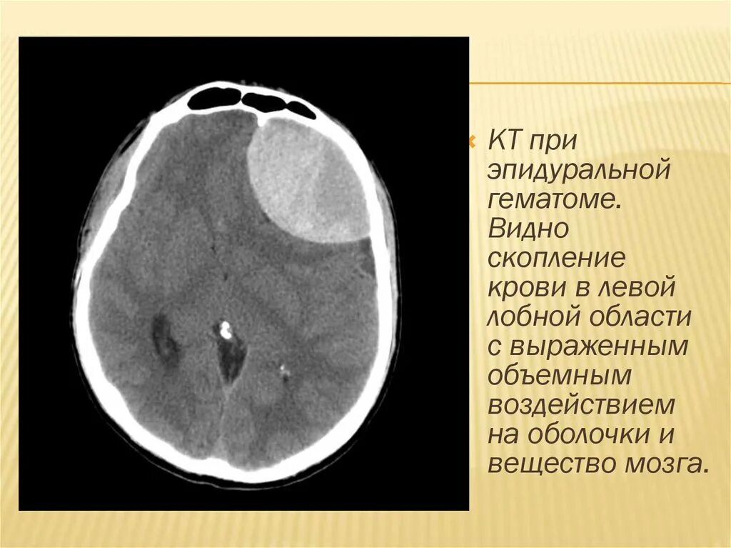 Объем гематомы на кт