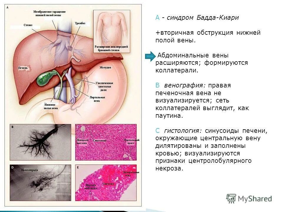 Тромбоз печеночных вен синдром бадда-киари. Синдром бадда киари клиника. Болезнь бадда киари клинические. Киари. Портальная гипертензия синдром бадда-киари.