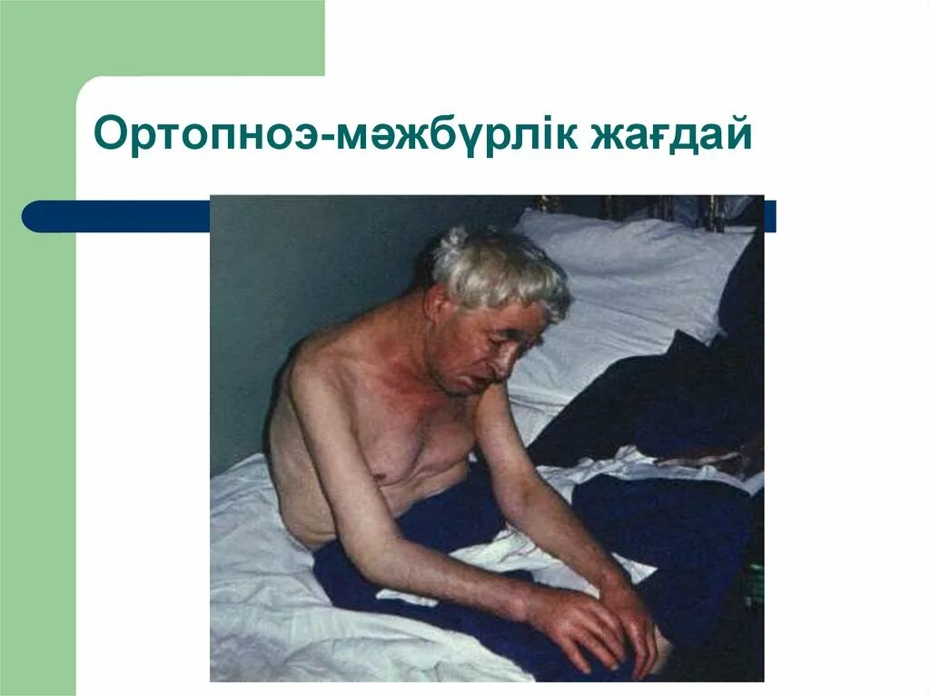 Положение при сердечной астме. Бронхиальная астма ортопноэ. сердечная недостаточность ортопноэ. положение ортопноэ при сердечной недостаточности. ортопноэ положение пациента.