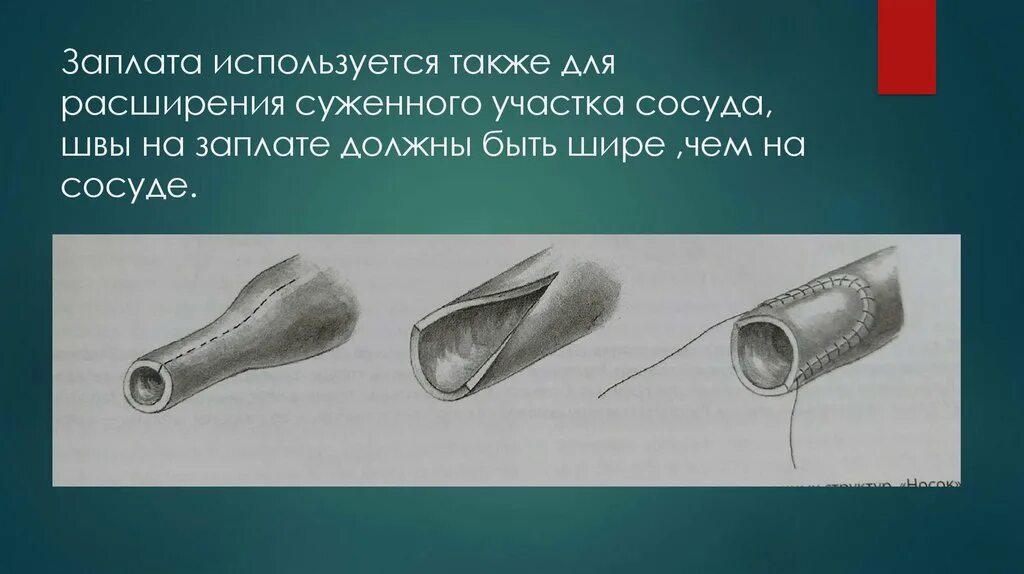 Механический шов сосудов. Заплата на заплате. Времен также была использована