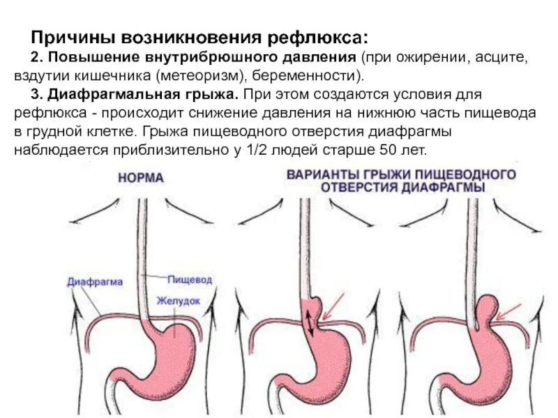 Рефлюкс у ребенка форум. Рефлюксная болезнь желудка рефлюкс. грыжа пищеводного отверстия диафрагмы лечебная гимнастика. гэрб, диафрагмальная грыжа.