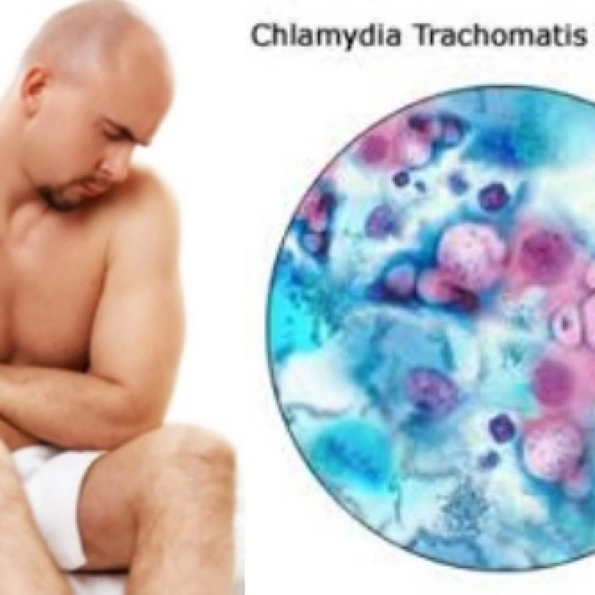 Chlamydia trachomatis. Хламидия трахоматис заболевания. Хламидии в организме человека. Хламидии заболевания у человека.