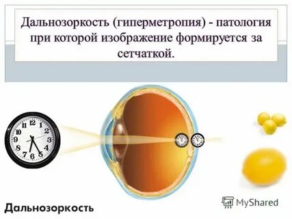 Гиперметропия слабой степени код