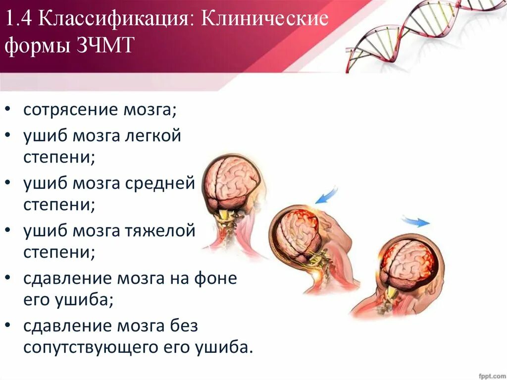 ЗЧМТ ушиб головного мозга классификация. Закрытая черепно-мозговая травма. ЧМТ сотрясение головного мозга.