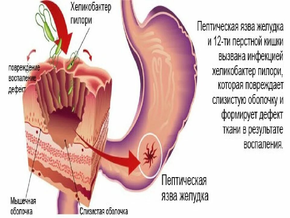 Фрукты при язве двенадцатиперстной кишки. Язва желудка и 12 перстной кишки. Язва желудка питание.