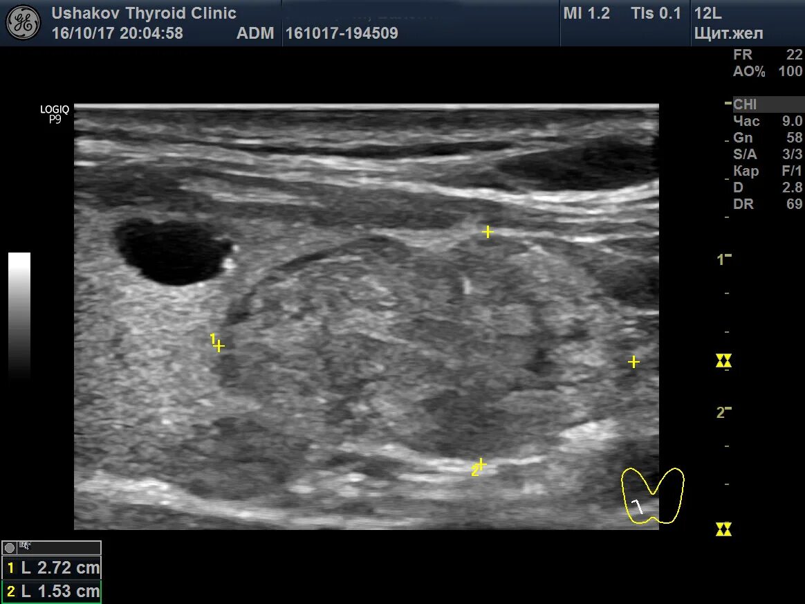 Классификация тирадс щитовидной железы УЗИ. УЗИ щитовидной железы Tirads. Tirads 4 щитовидная железа. Тирадс 2 щитовидной железы что это.