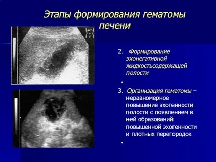Сколько опорожняется гематома