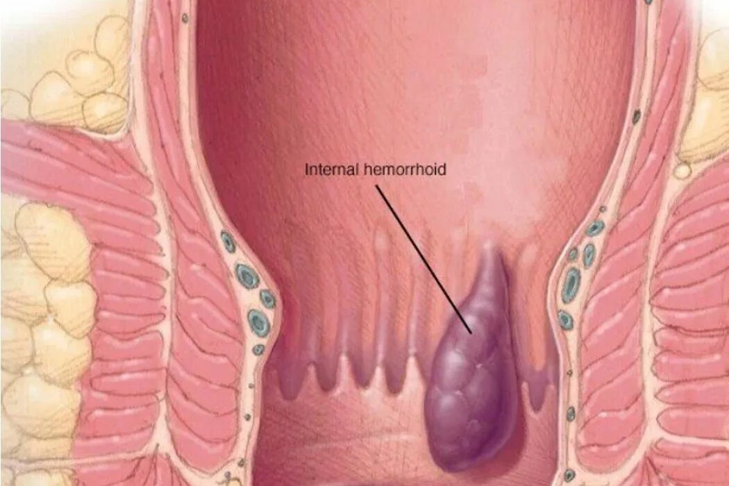 Трещина болит. Внешний наружный геморрой. Внутренние геморроидальные узлы.