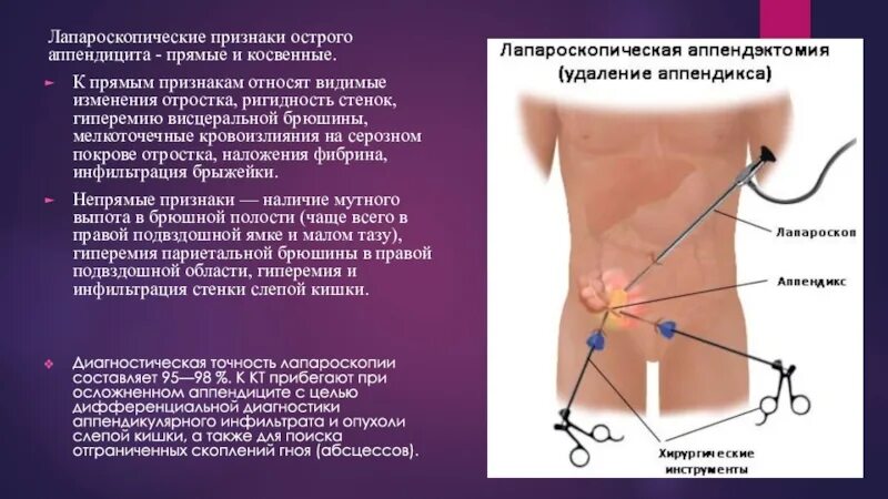 Аппендицит с какой стороны у взрослых женщин. Аппендицит с какой стороны у взрослых женщин