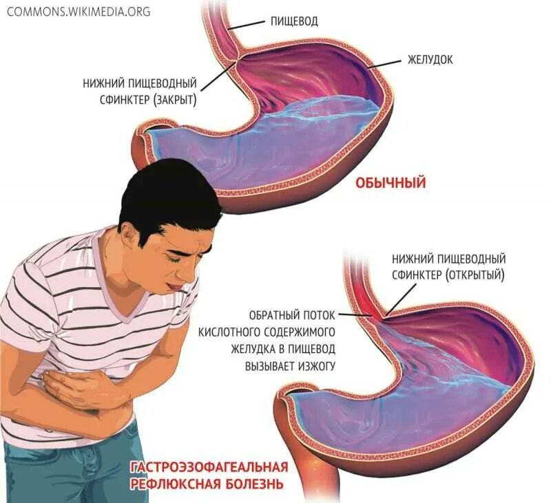 Боли после приема воды. Изжога причины.
