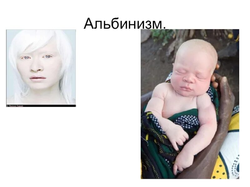 Альбинизм у человека презентация.