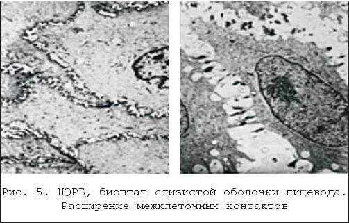 Неэрозивной рефлюксной болезнью (НЭРБ. Неэрозивную рефлюксную болезнь (НЭРБ). Неэрозивный ГЭРБ микроскопия. Неэрозивная форма нк1 ст. Биоптат слизистой оболочки