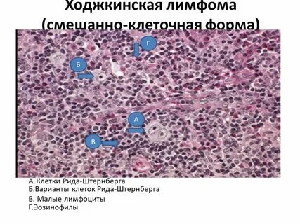 Смешанно клеточная лимфома