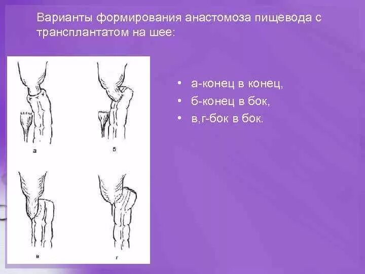 Формирование пищевода. Формирование анастомоза. Пищеводно желудочный анастомоз.