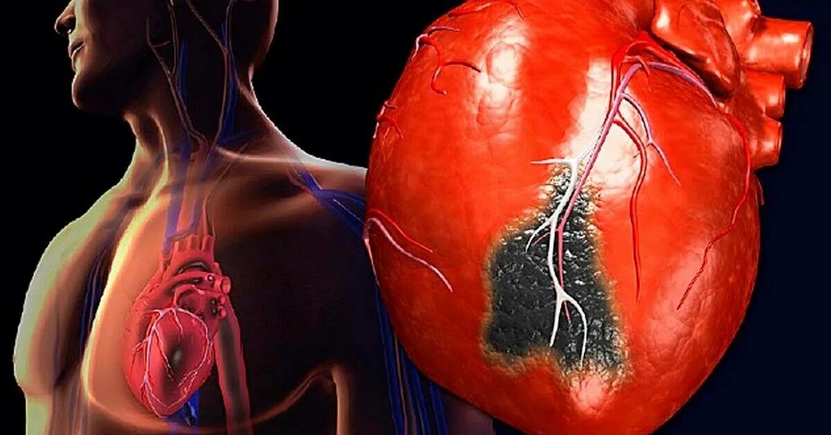 Осложнение на сердце после. Инфаркт миокарда сердце. Патологии сердца инфаркт миокарда. Ишемическая болезнь сердца инфаркт миокарда.