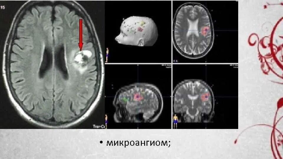 Кавернозная гемангиома головного мозга. Ангиома правой височной доли. Кавернозная ангиома мозжечка мрт. Ангиома головного мозга кт. Венозная ангиома головного мозга кт.
