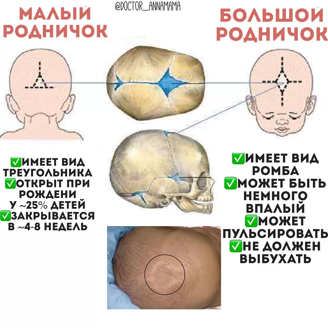 Когда заживает родничок. Большой Родничок 8 месяцев норма Родничок. Швы и роднички черепа. Большой и малый Родничок норма у новорожденных. Череп новорожденного большой и малый Родничок.