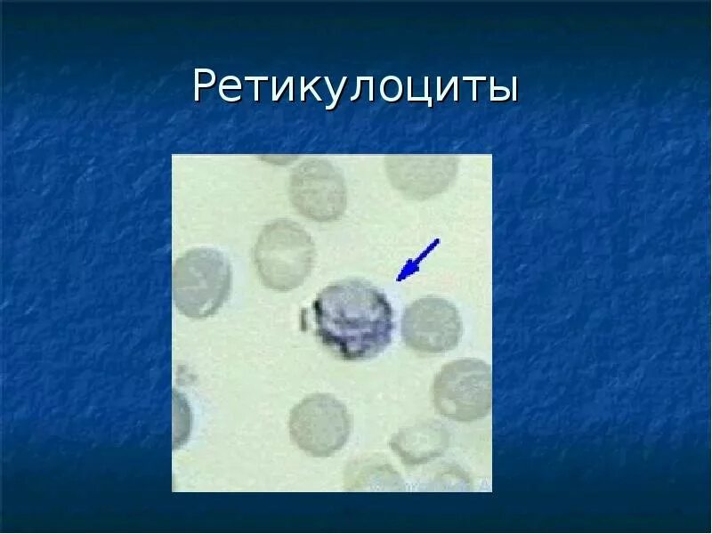 Абсолютные ретикулоциты повышены. Ретикулоциты микроскопия. Ретикулоциты микроскопия норма. Пунктатные ретикулоциты. Ретикулоциты в микроскопе.