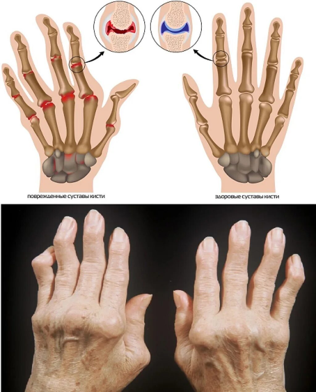 Изменения кисти рук. Манифестация ревматоидного артрита. Ревматоидный артрит apiterapiya.