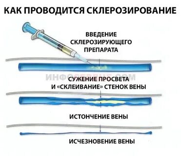 Склероскопия