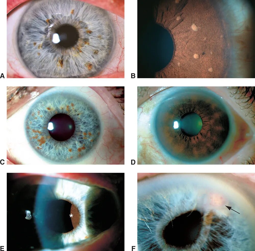 Желтые пятна на радужке глаза. Узловая меланома Радужки. Брушфильда пятна брушфильда.