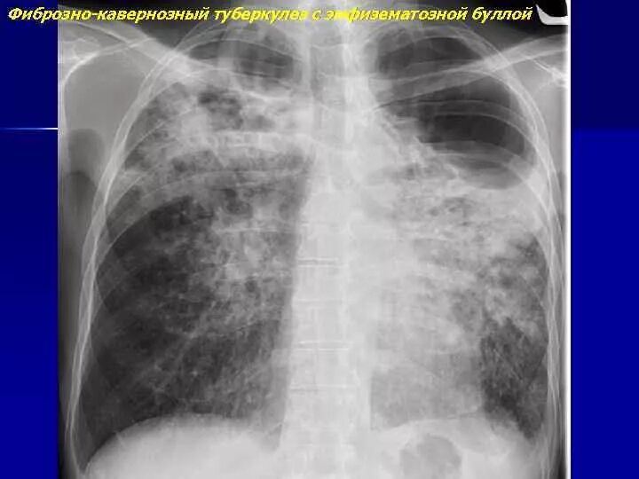 Кавернозный туберкулез рентген. Фиброзно-кавернозный туберкулез рентген. Фиброзно-кавернозный туберкулез легких рентген. Фиброзно-кавернозный туберкулез каверны.